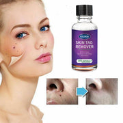 Cross-Border Eelhoe Skin Verrucous Remover