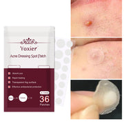 Acne Spot Patch & Pimple Remover Se