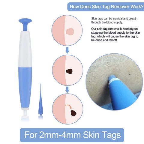 Skin Tag Removal Kit (Home Use)